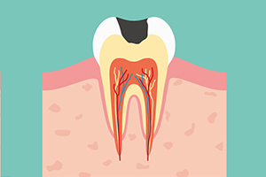 象牙質までの虫歯
